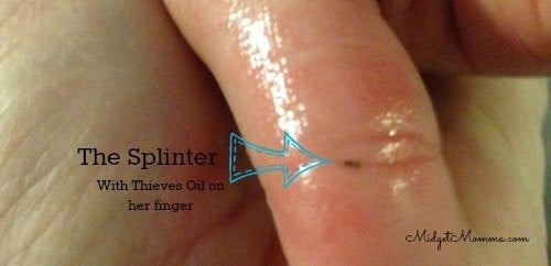 How to Remove Splinters using Thieves oil Essential oils