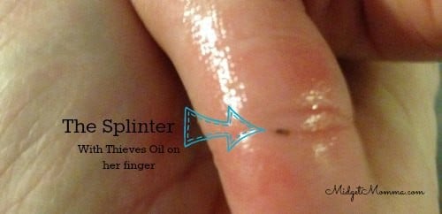 Using thieves essential oils to remove splinter