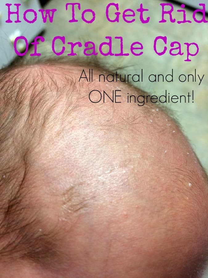 How To Get Rid Of Cradle Cap